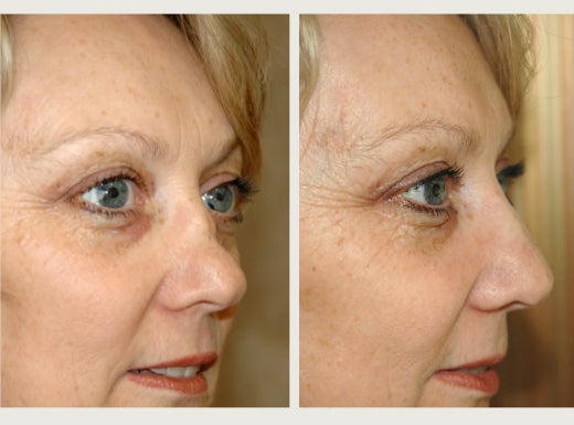 Non-Surgical Rhinoplasty